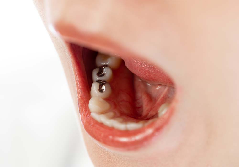 永久歯もむし歯になりやすくなる