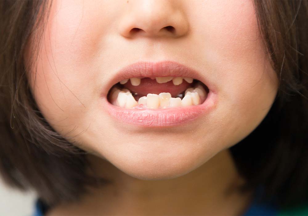 歯並びが悪くなることも