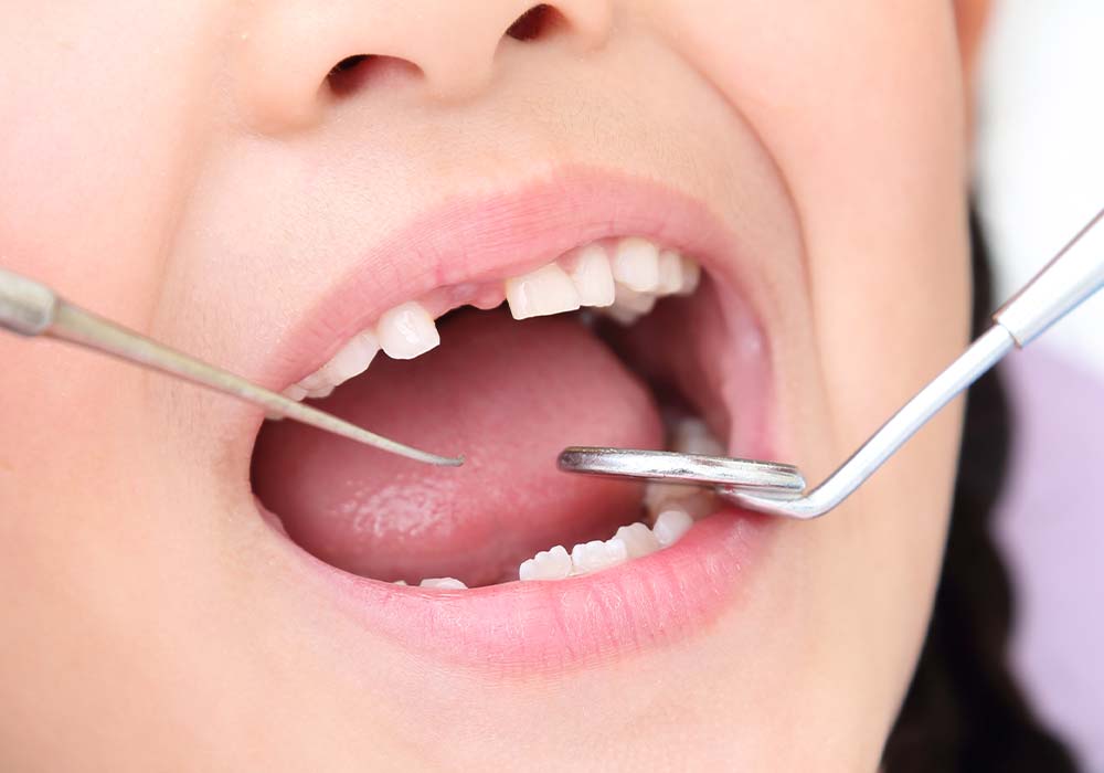 子どものむし歯の特徴