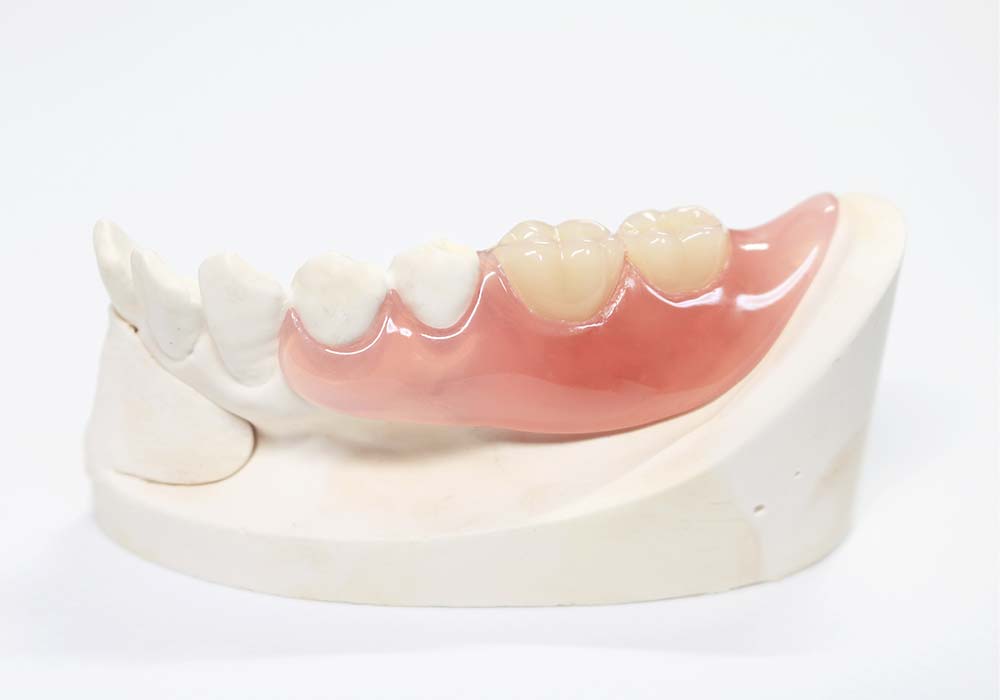 ンクラスプデンチャー