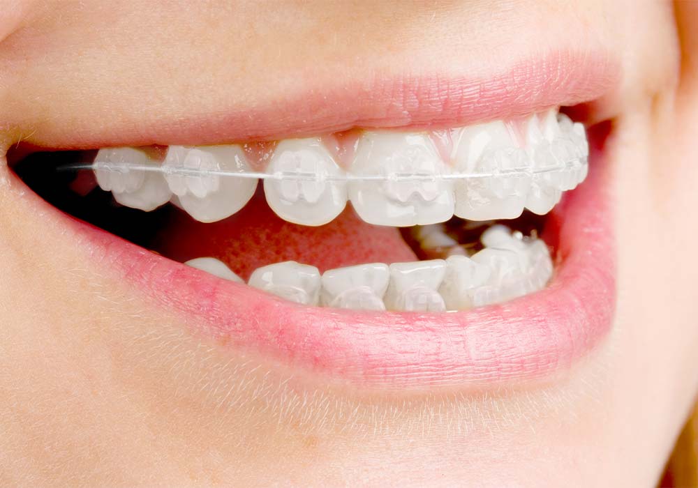 ワイヤー矯正(透明ブラケット)