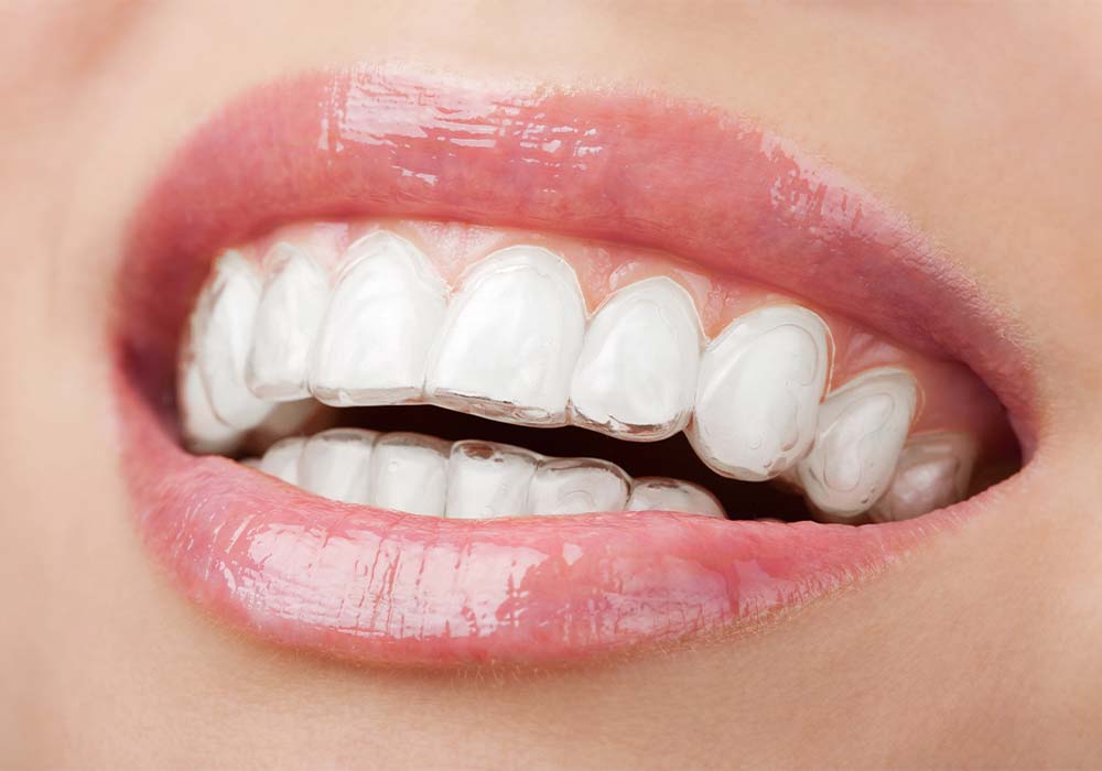 マウスピース型矯正装置