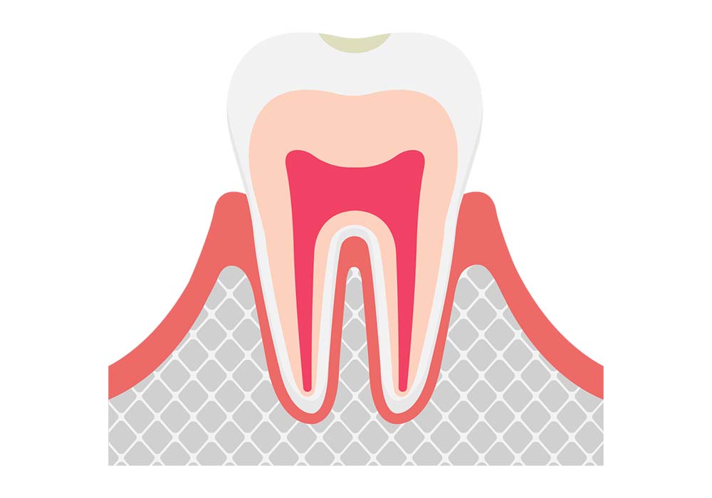 初期むし歯