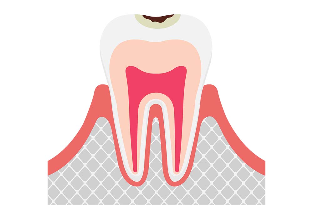 エナメル質のむし歯