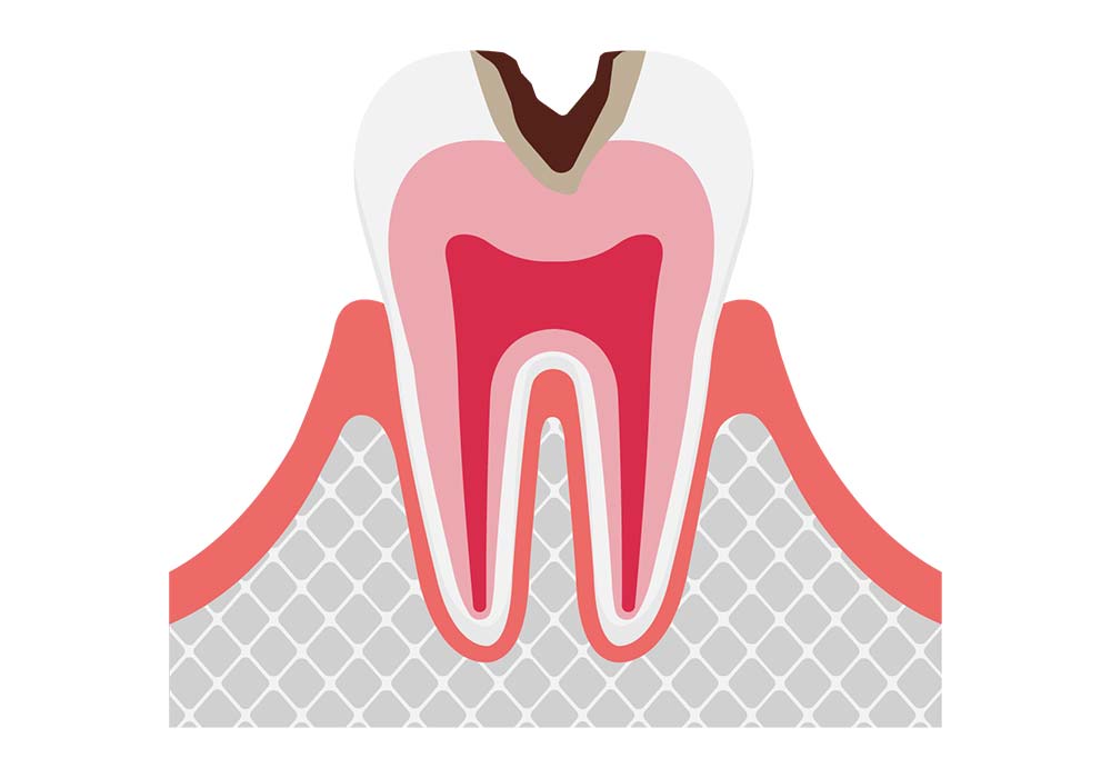 象牙質まで進行したむし歯