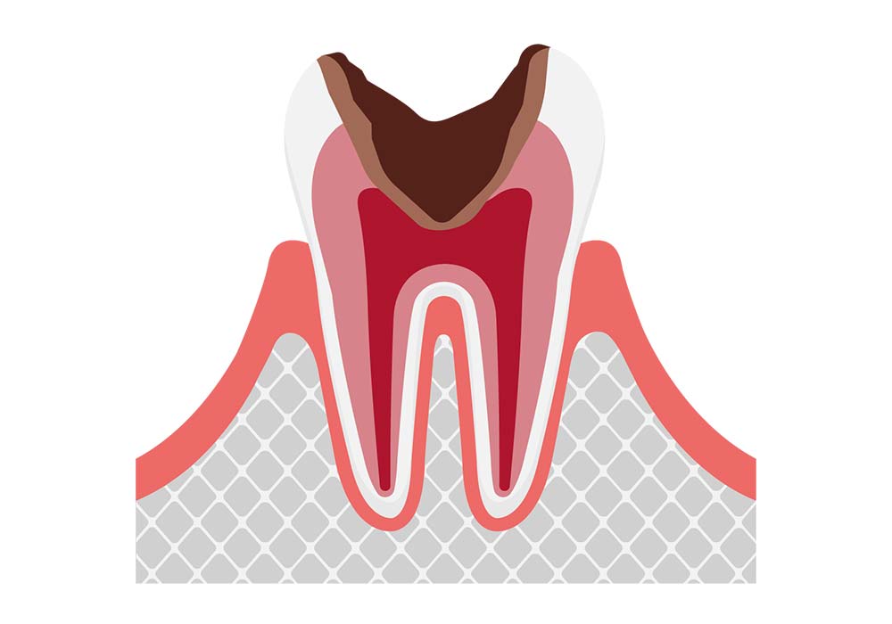 神経まで進行したむし歯