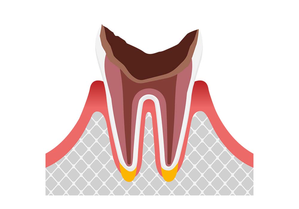 歯根だけ残ったむし歯