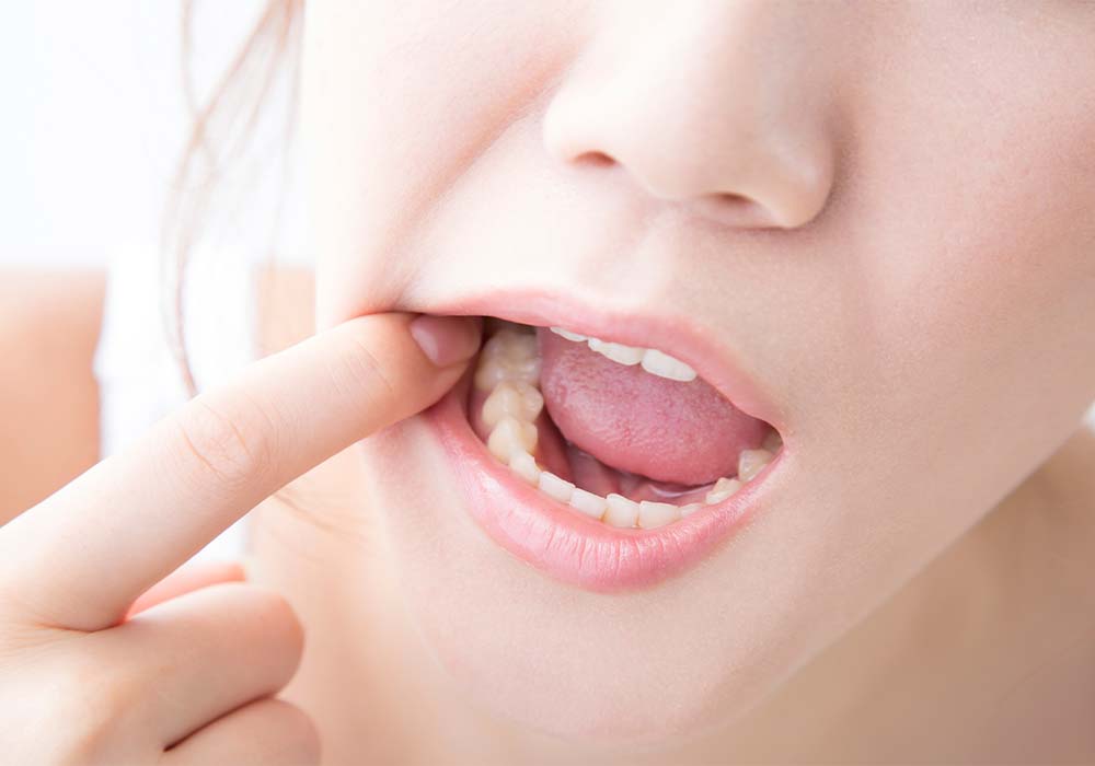 大人のむし歯の特徴