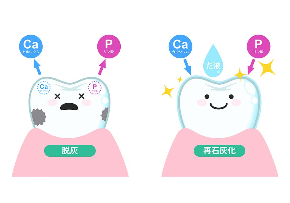 むし歯が発生する仕組み