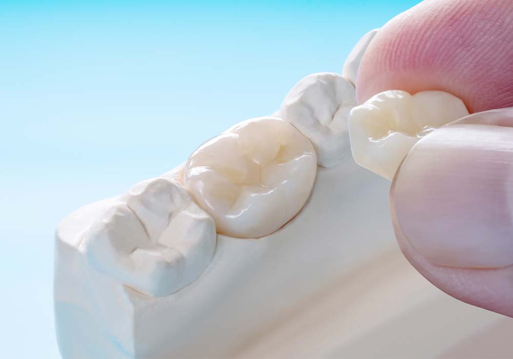 セラミックの詰め物・被せ物