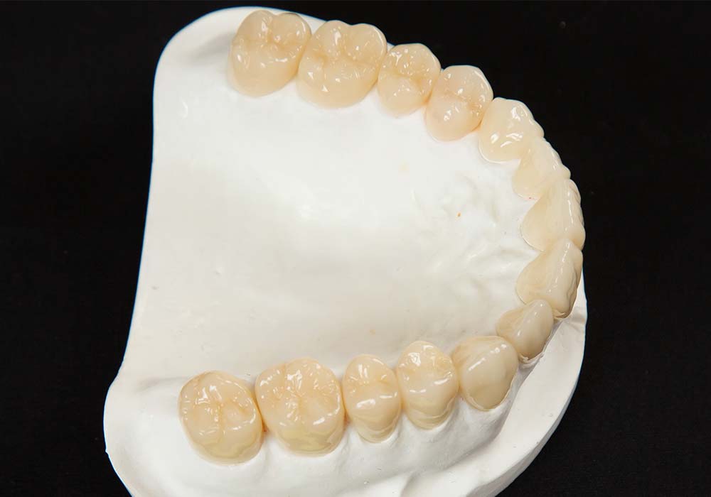 ハイブリッドの詰め物・被せ物