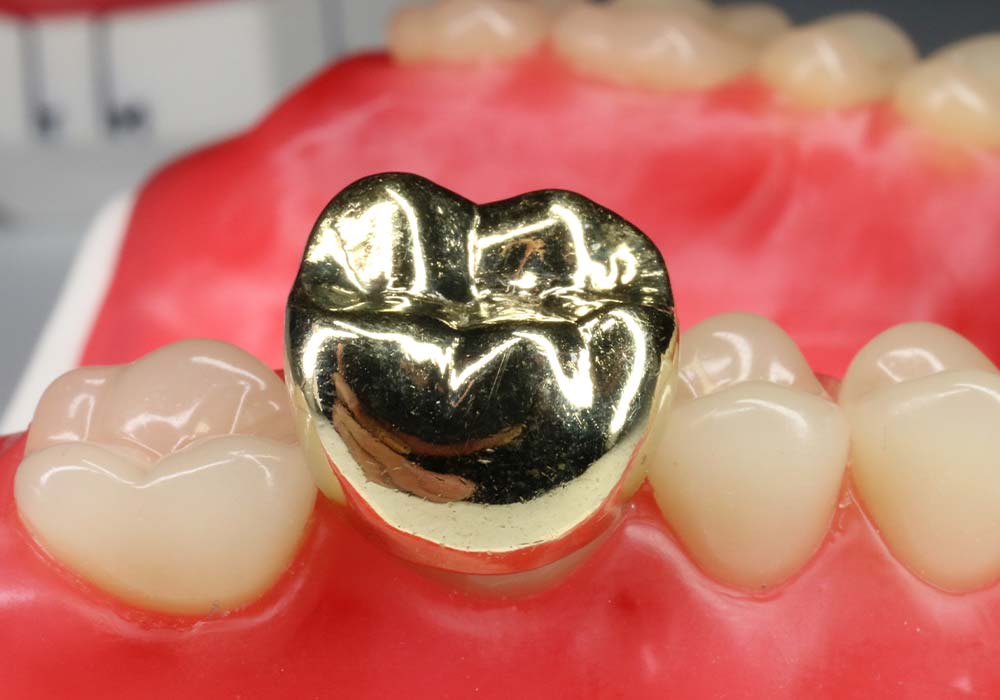 ゴールドの詰め物・被せ物