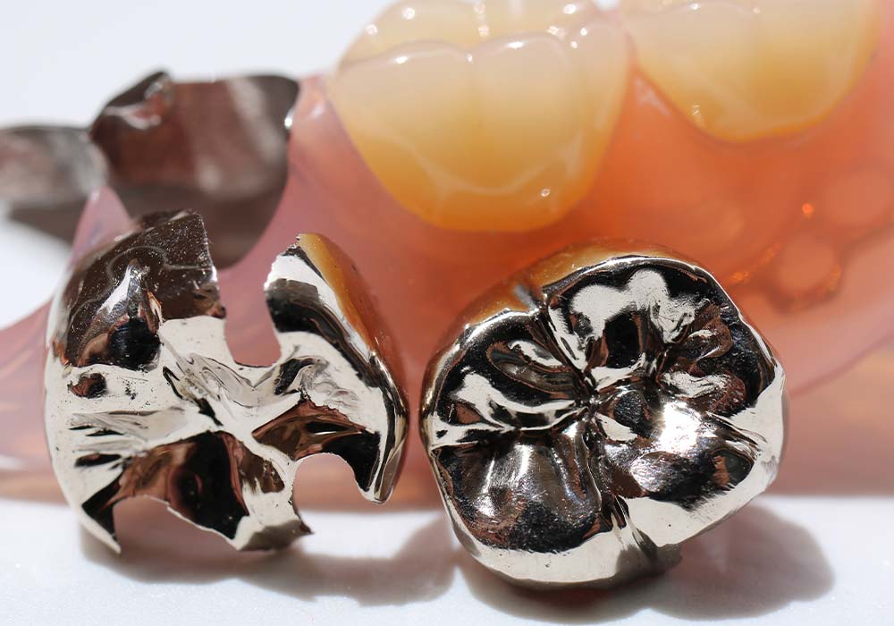 銀歯の詰め物・被せ物