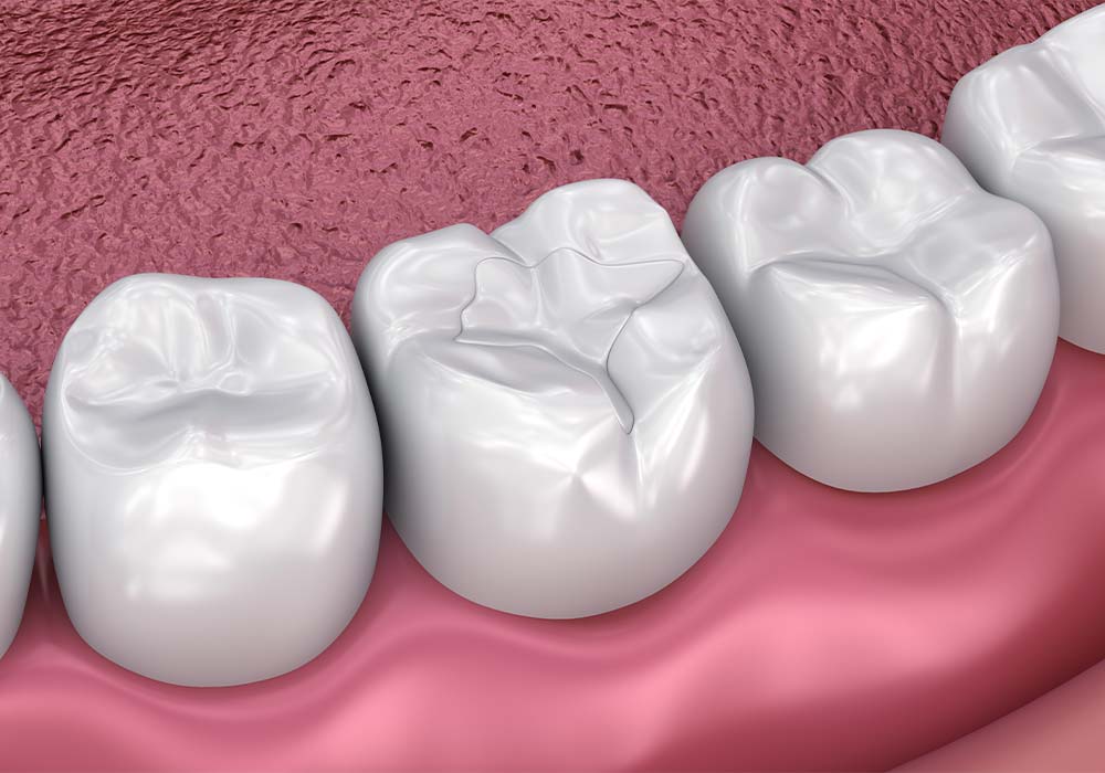 レジンの詰め物