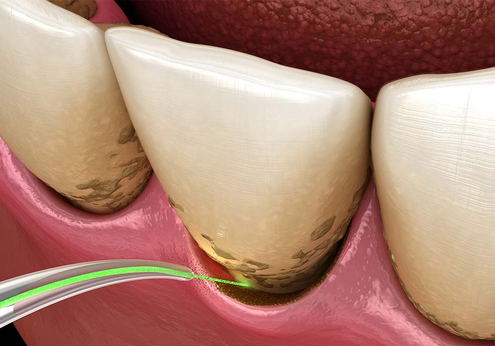 進行した歯周病の治療