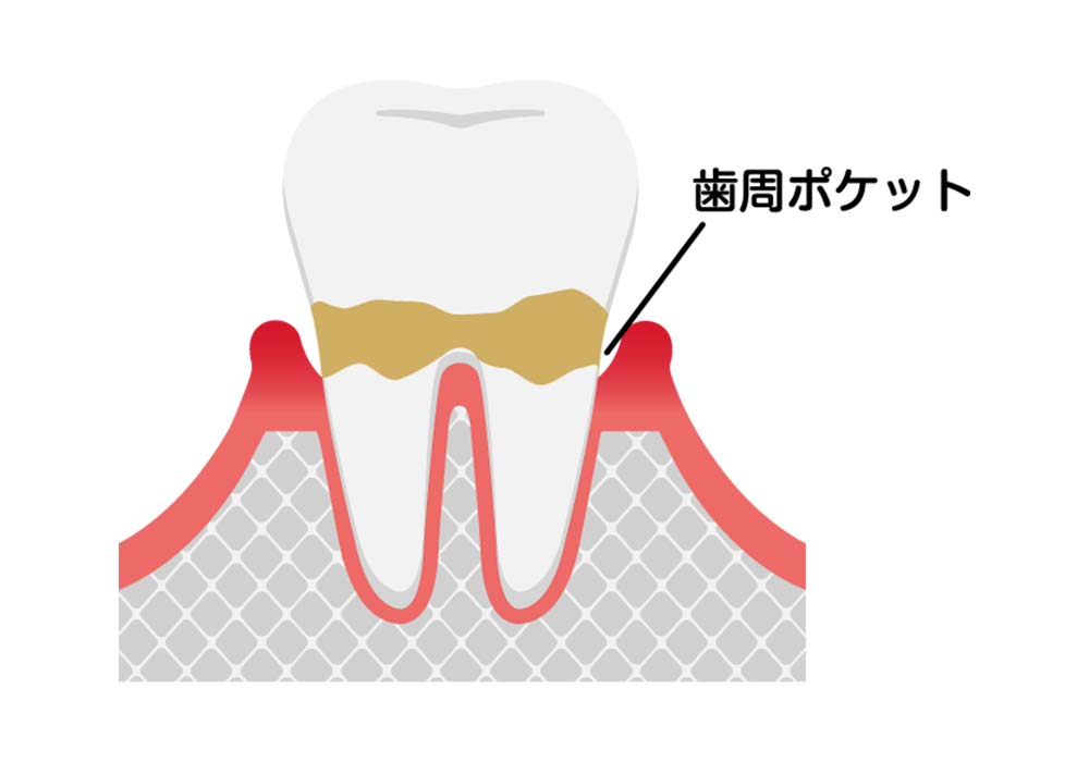 歯周炎(軽度)