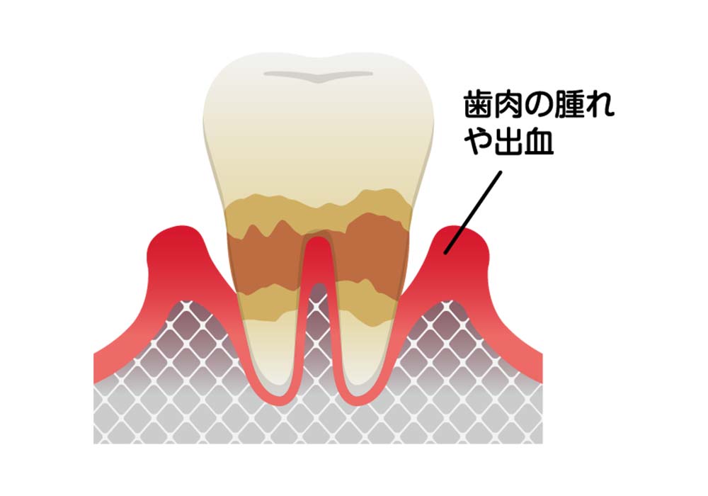 歯周炎(中度)