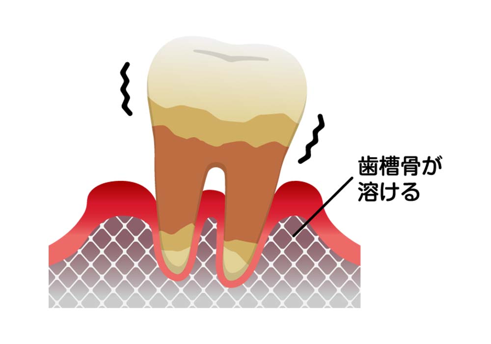 歯周炎(重度)